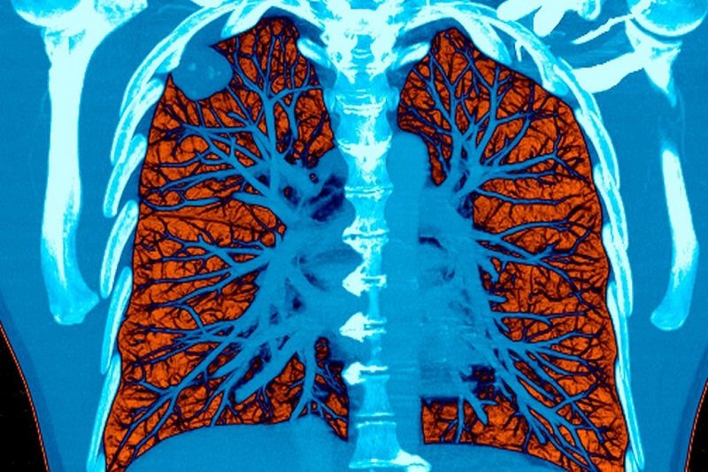 Đưa công nghệ AI vào xác định sớm ung thư phổi